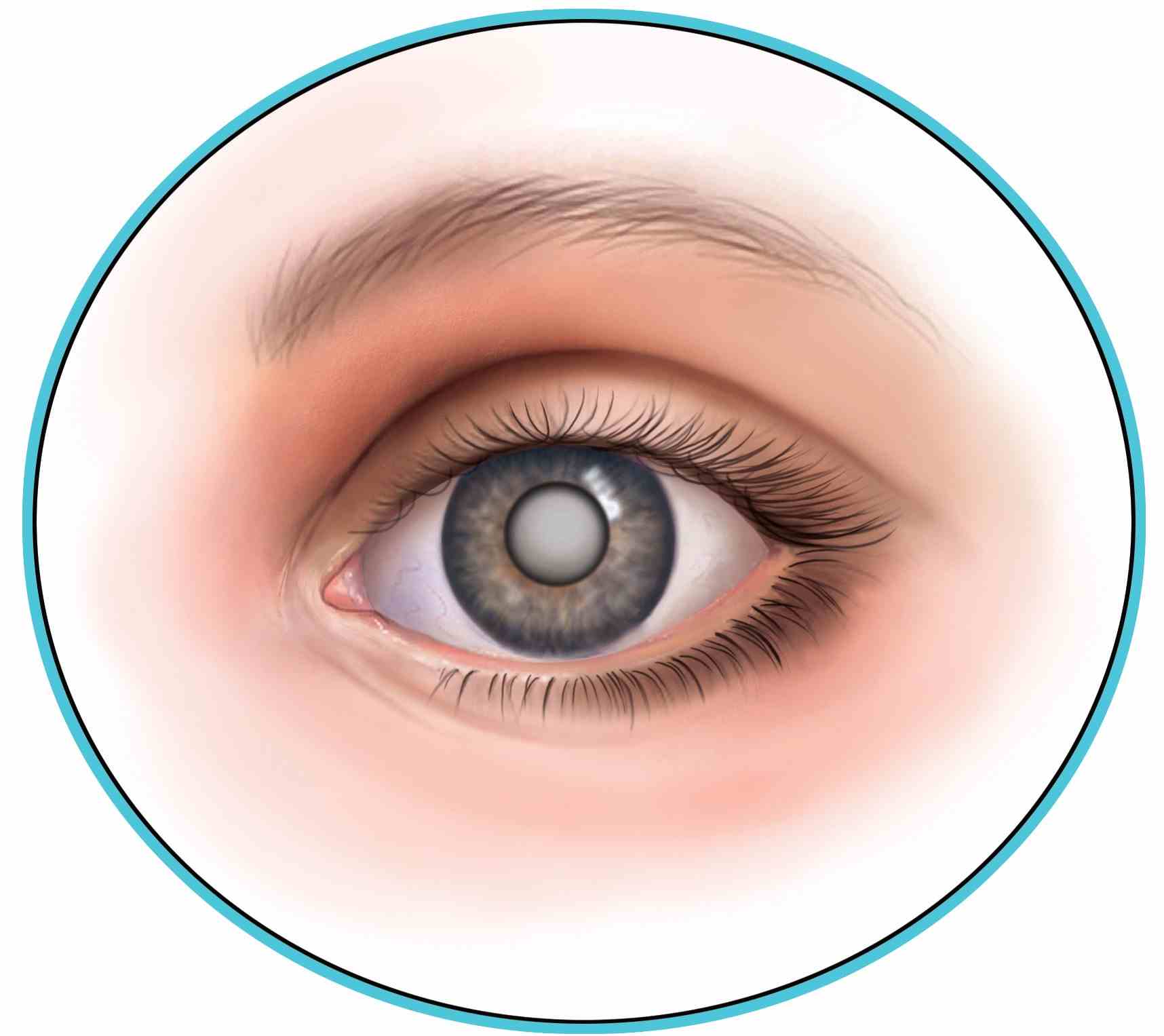 Cataract Course